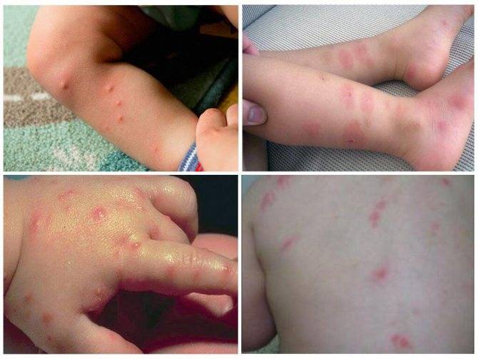 Аллергия на кошек: проявление, признаки у детей и взрослых, лечение