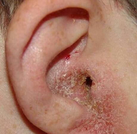 Появление кровянистых выделений при воспалении ушей – что значит?