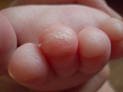 Почему у детей может лопается кожа на пальцах рук