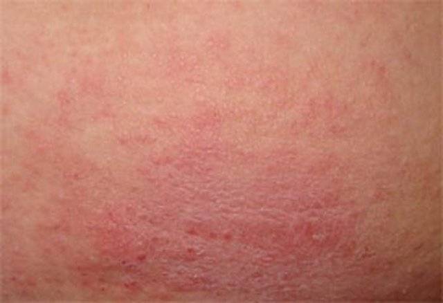 Сыпь на ногах у ребенка (31 фото): причины красной мелкой сыпи с пояснениями, без температуры на щеках у грудного ребенка