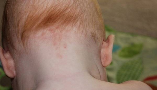 Кожа ребенка: сыпь, пятна, диатез. как распознать и лечить? пигментные пятна, опрелости, потница у новорожденных