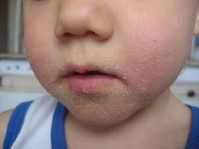 Сыпь на спине у ребенка (20 фото): причины красных высыпаний - пояснения