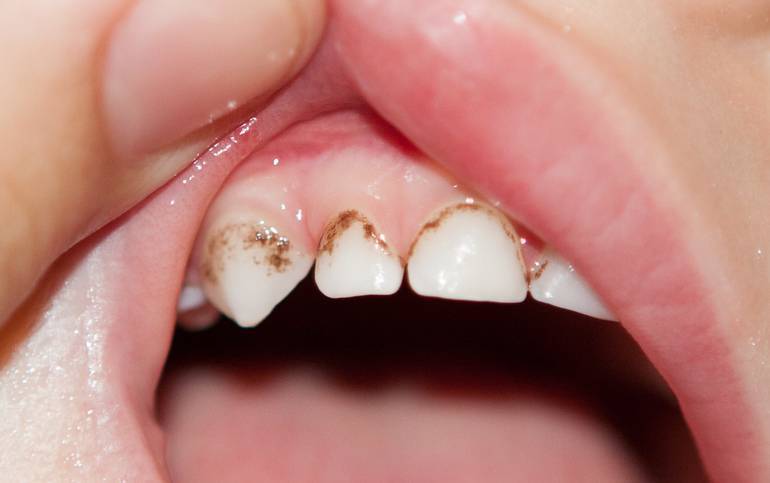 Молочные зубы выпали а новые не растут – надо ли бить тревогу?