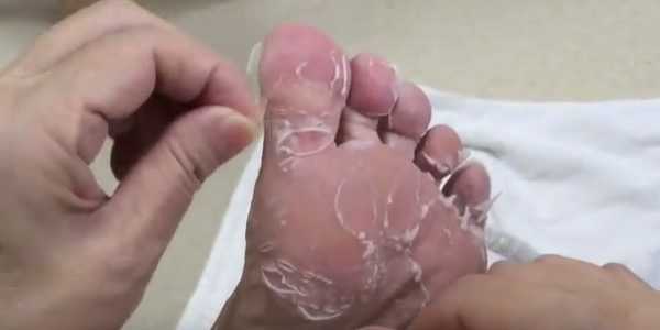 Шелушение кожи и покраснение на пальцах ног и ступнях у ребенка и взрослого