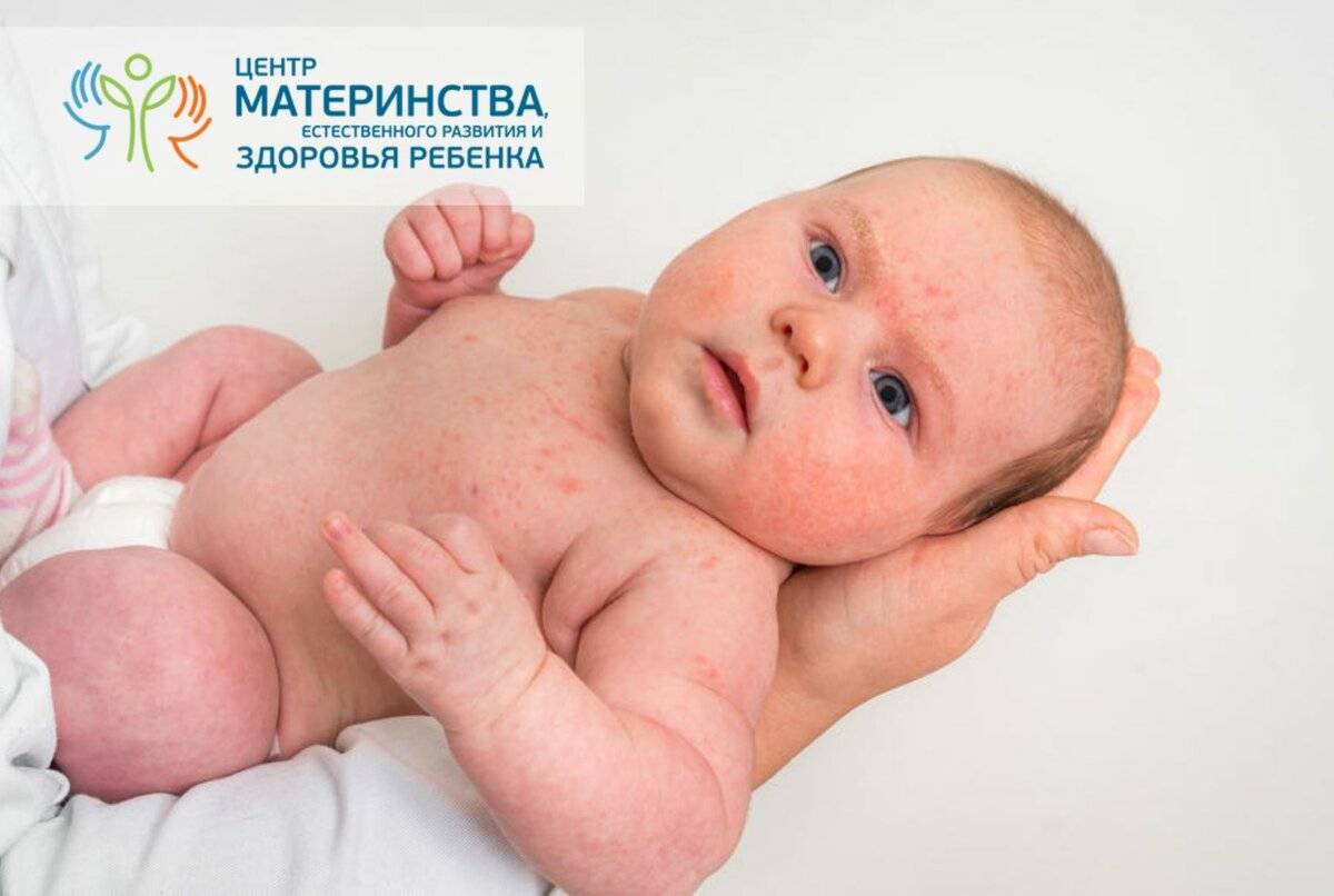 Цветение новорожденных: что делать и как лечить кожу у грудничка