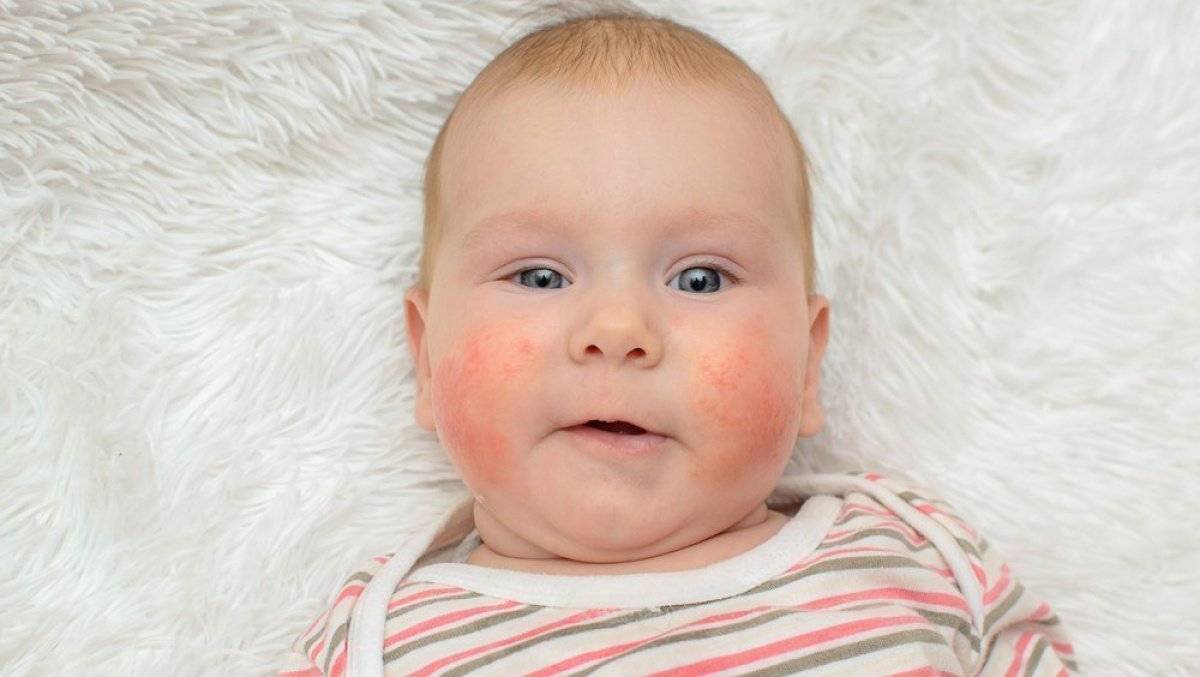 У ребенка сухая кожа или шелушащиеся пятна на теле: причины возникновения и возможные диагнозы