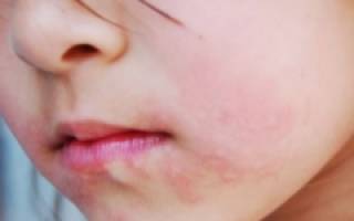 Доктор комаровский о причинах сухости кожи у ребенка