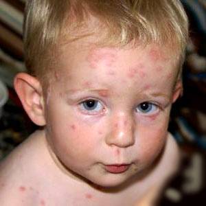 Как выглядит различная сыпь на коже у детей?
