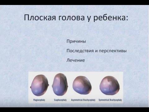 Изменеие формы черепа в 4, 5 мес, из-за кривошеи, тонуса?что делать-то? - запись пользователя вилли-винки (rvetka) в сообществе здоровье новорожденных в категории кривошея - babyblog.ru