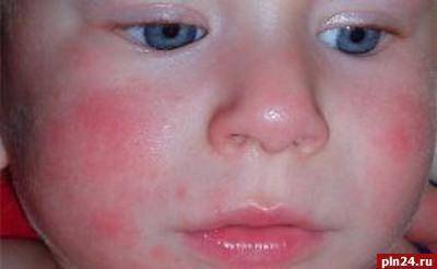 У ребенка зуд в паховой зоне. причины, лечение зуда кожи