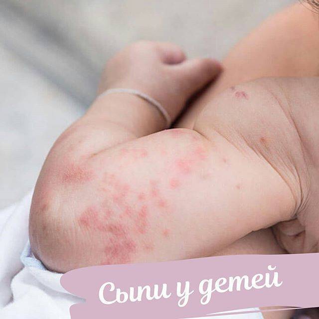 Allergiya-v-vide-krasnyh-pyaten-na-tele - запись пользователя катюша (katerin_ka_) в сообществе здоровье новорожденных в категории кожные заболевания - babyblog.ru