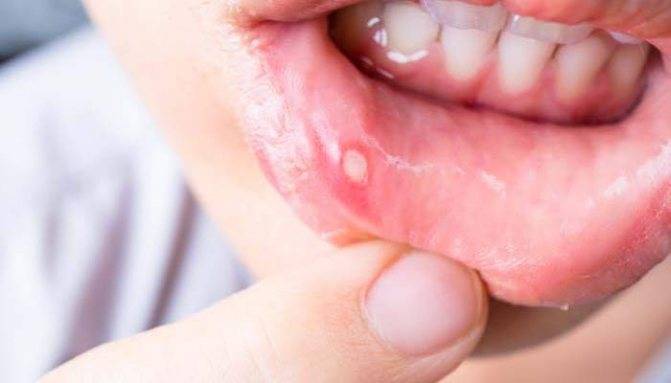 Сыпь у рта ребенка - фото, все причины и лечение
