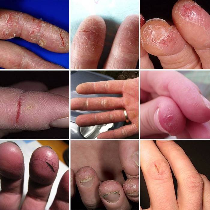 Почему у ребенка слезает кожа на пальцах рук?