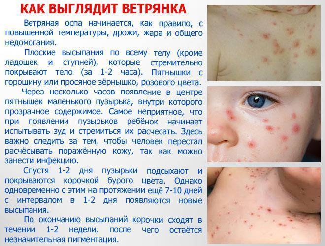 Сыпь на теле у ребенка фото с пояснениями. аллергическая сыпь у детей фото без температуры.