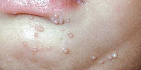 Моллюски на коже у ребенка — причины и способы лечение