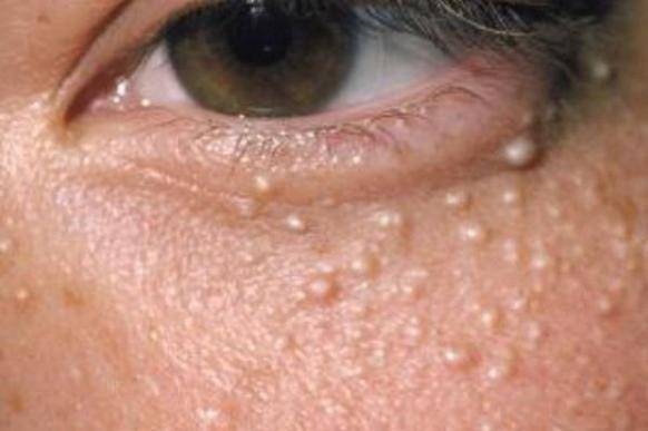 Контагиозный моллюск у ребенка (33 фото): лечение кожи и тела, удаление кожного моллюска на лице, причины и симптомы на начальной стадии