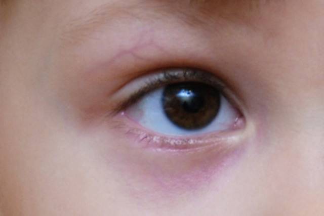 Синяки под глазами у ребенка: причины и лечение, что это значит?
