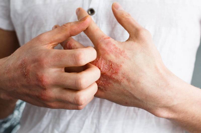 Аллергия на сгибе локтя у ребенка: симптомы, фото, причины и лечение || раздражение на сгибе руки с внутренней стороны