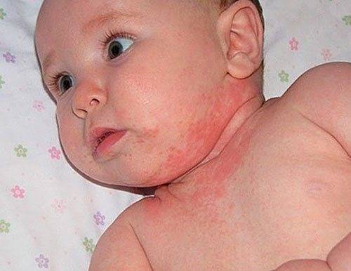 Что делать, если появилась сыпь на лице у ребенка?