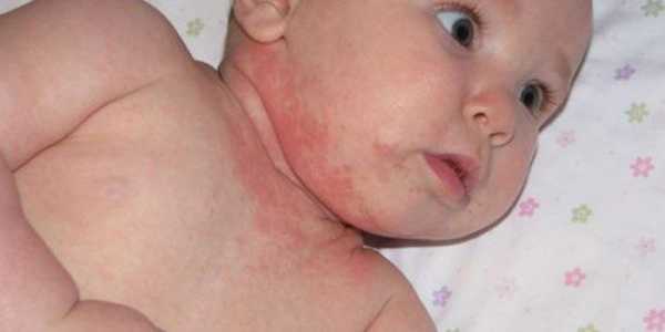 Может ли быть аллергия на грудное молоко у ребенка?
