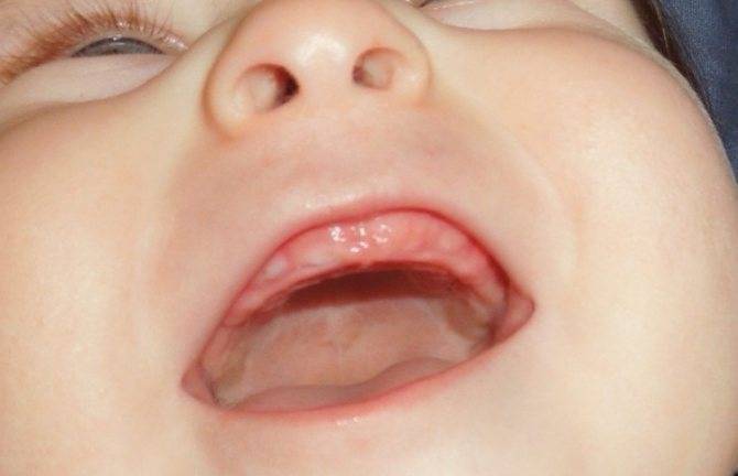 Сыпь у грудничка: фото и описание высыпаний у новорожденного