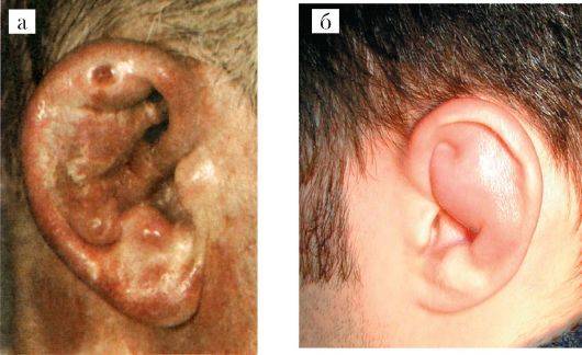 Кровь из уха: причины, что делать, лечение
