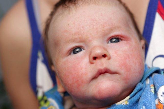 Сыпь по всему телу без температуры у ребенка (41 фото):  причины с пояснениями, красная мелкая сыпь и зуд