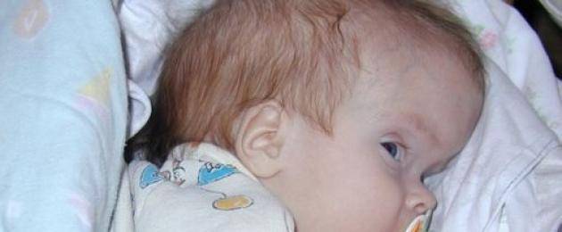 Почему у новорожденного ребенка большой, выпуклый лоб