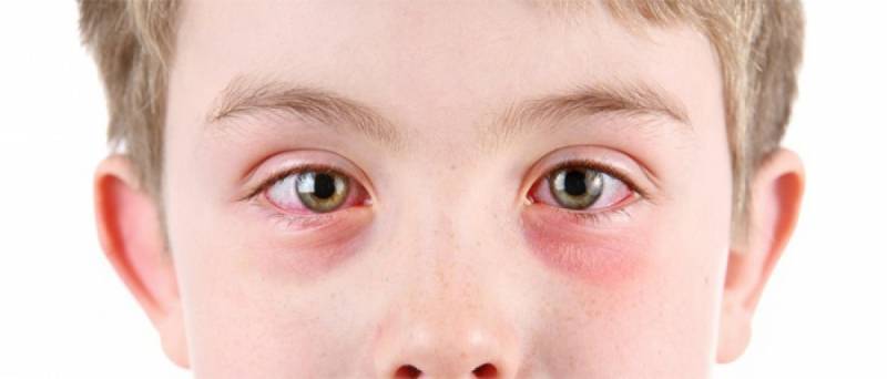 Почему ребенок чешет и трет глаза: причины, симптомы заболеваний, лечение
