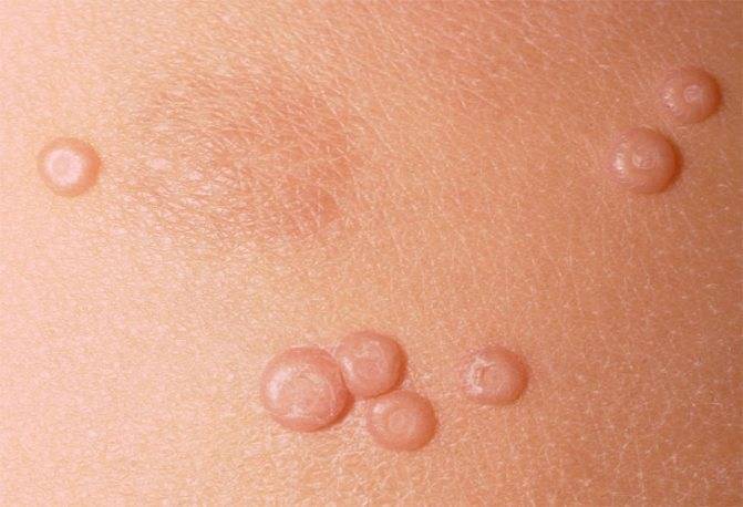 Е. комаровский: контагиозный моллюск у детей (11 фото) лечение и симптомы на коже