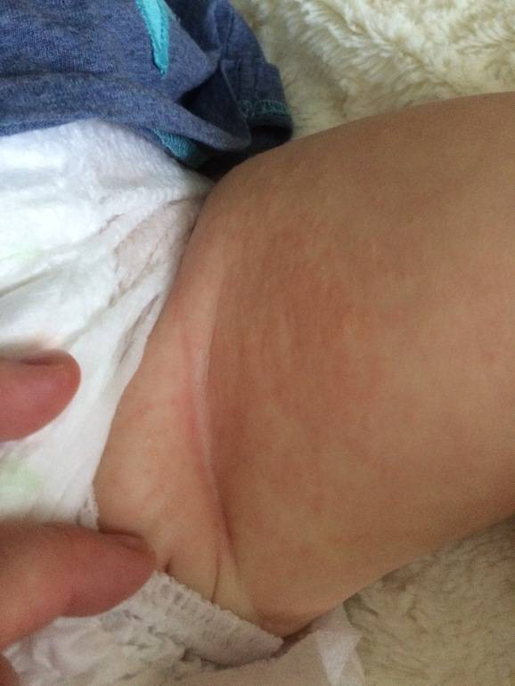 Аллергия на памперсы – как проявляется реакция у малыша, и что делать родителям?