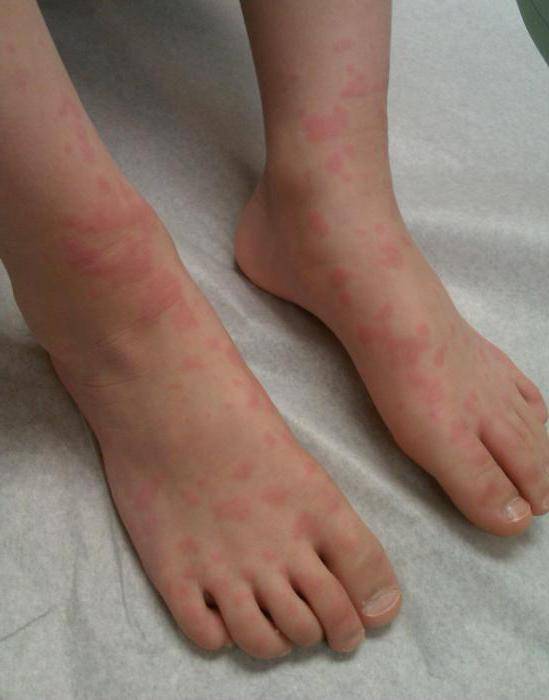 Аллергия на ногах у младенца: причины и лечение