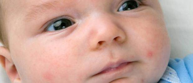 Прыщи на лице у новорожденного, на теле (24 фото): гормональные прыщи в месяц, белые и красные у грудничка