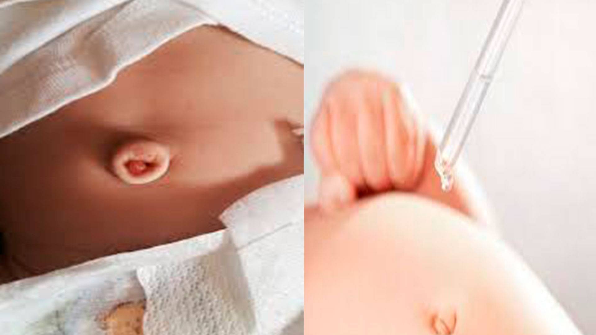 Внимание - пупок!  обработка пупка новорожденного в роддоме и дома. как ухаживать за пупком новорожденного