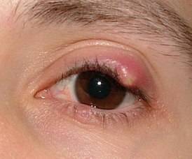 Ангиопатия сетчатки глаза у ребенка