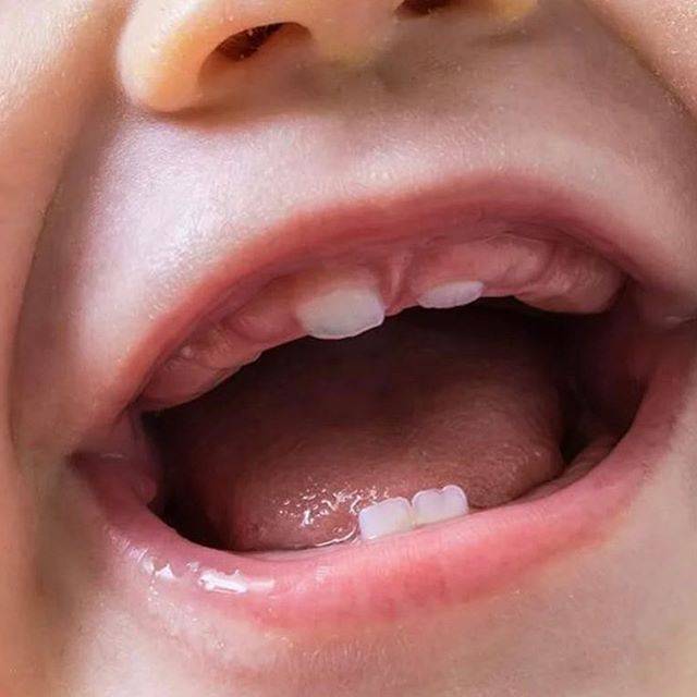 Обезболивающие гели, мази, капли и свечи при прорезывании зубов