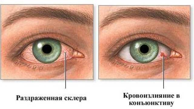 Что делать, если лопнул капилляр в глазу у ребенка – экстренная помощь
