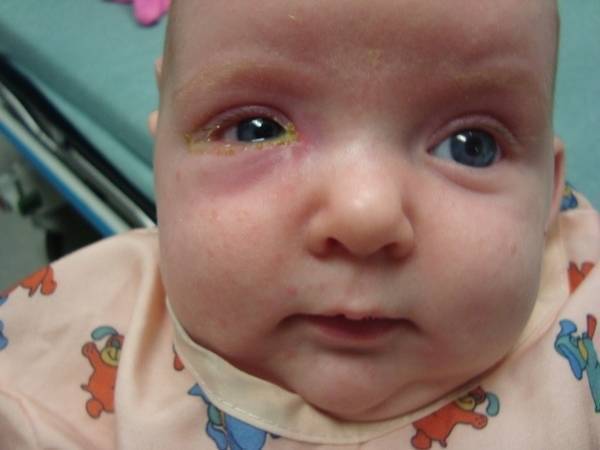 Мешки под глазами у ребенка: причины возникновения, лечение, советы