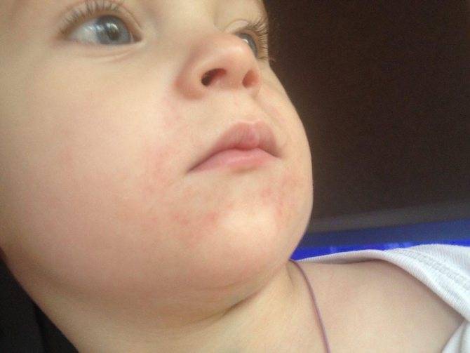 Сыпь на щеках у грудного ребенка. фото, что это значит, что делать, как лечить
