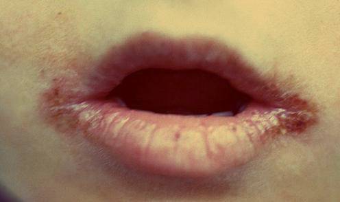 Заеды в уголках рта у детей: причины и лечение, чем можно мазать и как вылечить заболевание
