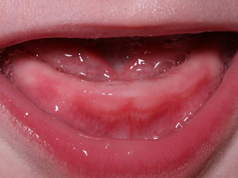 Симптомы прорезывания зубов у грудничков 4 месяца