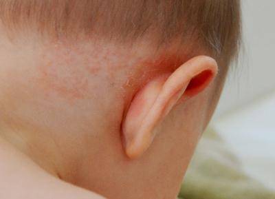 Сухие корочки за ушами у ребенка и шелушение — что делать