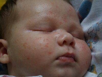 Сыпь у ребенка 1 месяц - аллергическая сыпь на щеках у ребенка - запись пользователя вика (id1579765) в сообществе здоровье новорожденных в категории аллергия - babyblog.ru