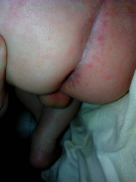 Красная попка у месячного ребенка - запись пользователя туська (norejro7) в сообществе здоровье новорожденных в категории кожные заболевания - babyblog.ru