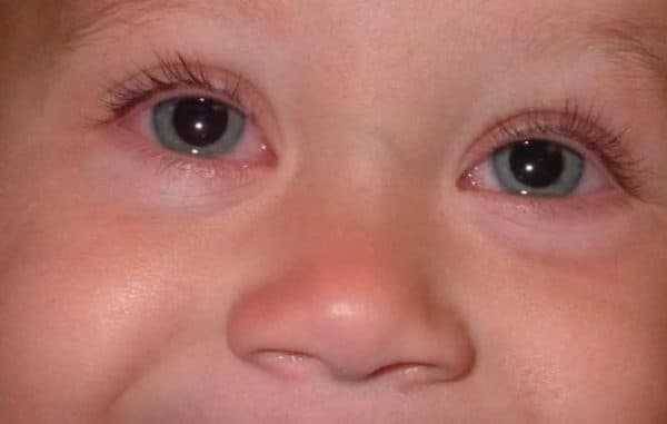 Гноится глаз у ребенка: причины, лечение
