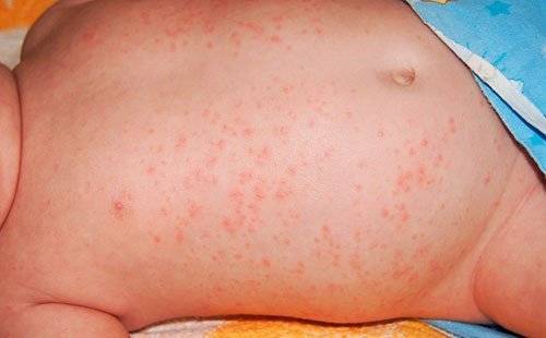 Красные пятна у ребенка - если не аллергия, то что это: фото и названия болезней