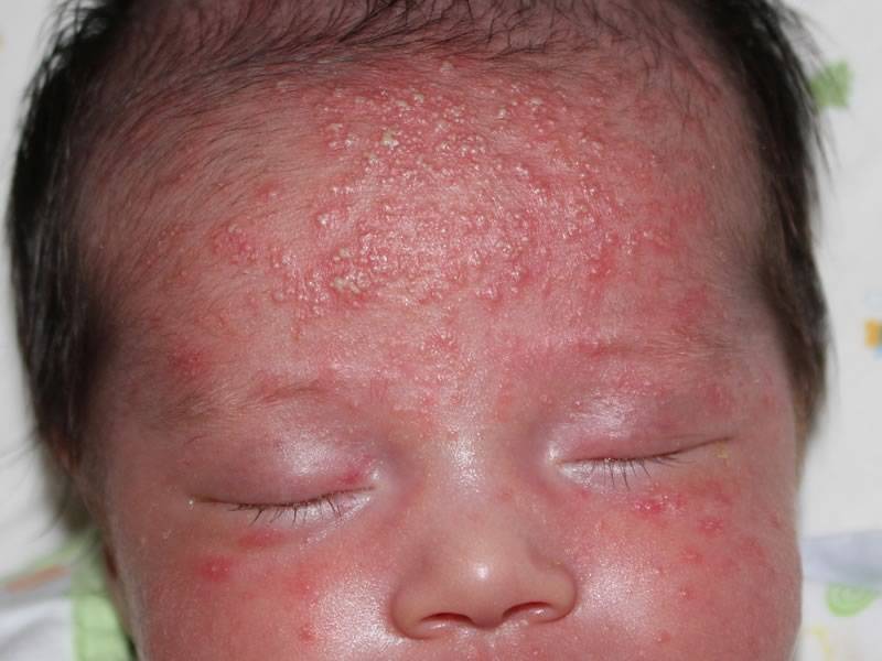 Сыпь на лице у грудничка, новорожденного ребенка (54 фото): таблица детских инфекций с пояснениями, причины красной мелкой сыпи на щеках - прыщей на шее и теле, симптомы без температуры