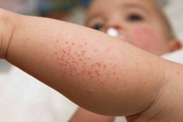Сыпь на ногах у ребенка (31 фото): причины красной мелкой сыпи с пояснениями, без температуры на щеках у грудного ребенка