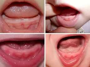 Симптомы прорезывания зубов у грудничков и сроки