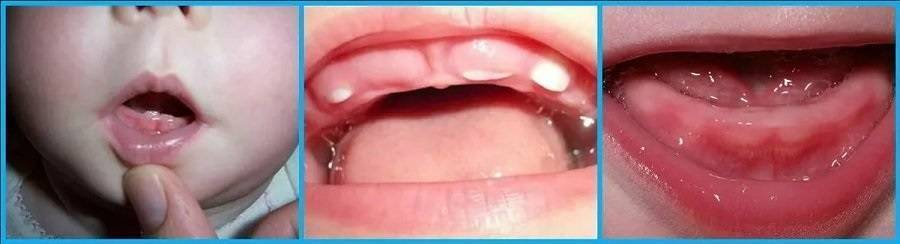 Во сколько месяцев у ребенка начинают резаться зубы
